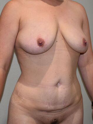 Mommy Makeover: Case 301 - Before