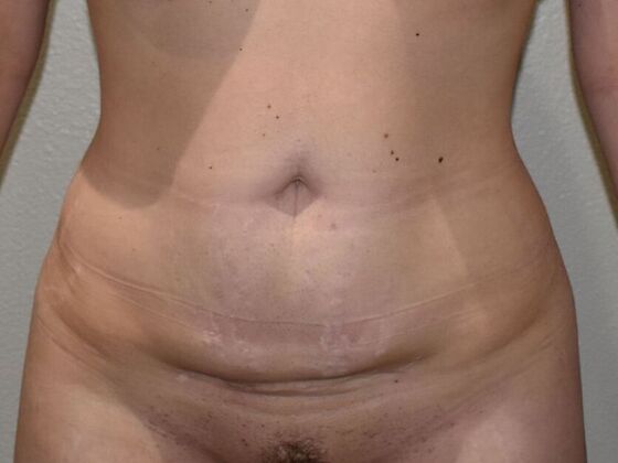 Tummy Tuck (Abdominoplasty): Case 472 - Before