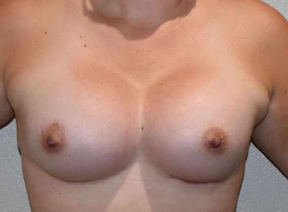 Breast Augmentation Case 758 - After