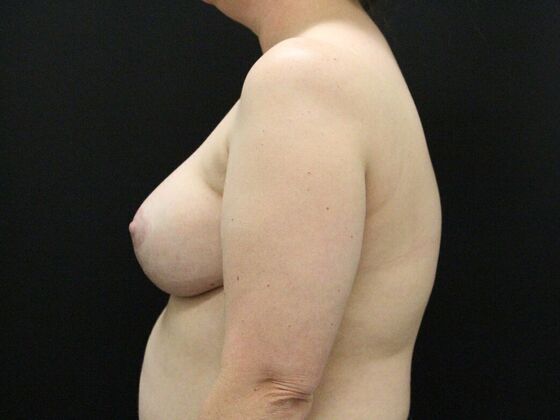 Breast Lift & Breast Lift Augmentation: Case 28 - After