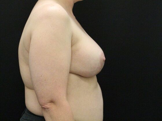 Breast Lift & Breast Lift Augmentation: Case 28 - After