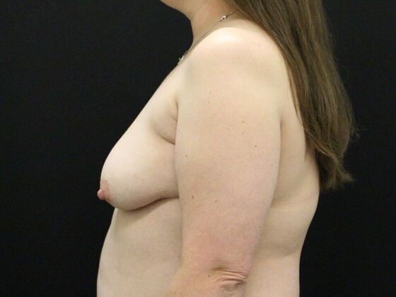 Breast Lift & Breast Lift Augmentation: Case 28 - Before