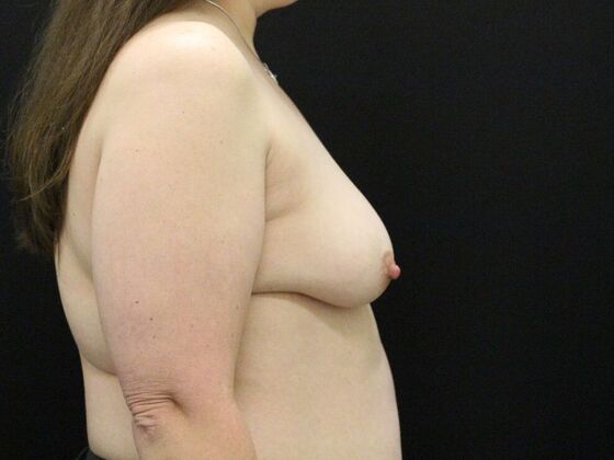 Breast Lift & Breast Lift Augmentation: Case 28 - Before