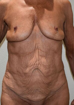 Mommy Makeover Case 302 - Before