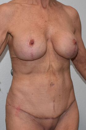 Mommy Makeover: Case 302 - After