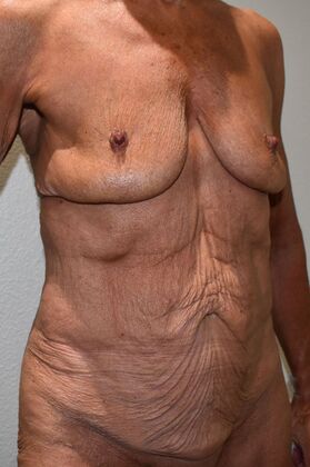 Massive Weight Loss : Case 149 - Before