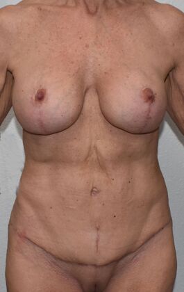 Massive Weight Loss : Case 149 - After