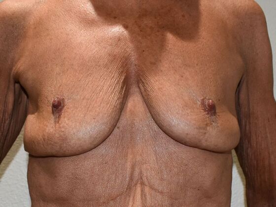 Breast Augmentation w/ Lift Case 529 - Before