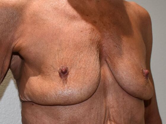 Breast Augmentation w/ Lift: Case 529 - Before