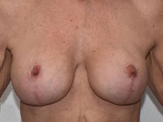 Breast Augmentation w/ Lift Case 529 - After