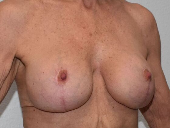 Breast Augmentation w/ Lift: Case 529 - After