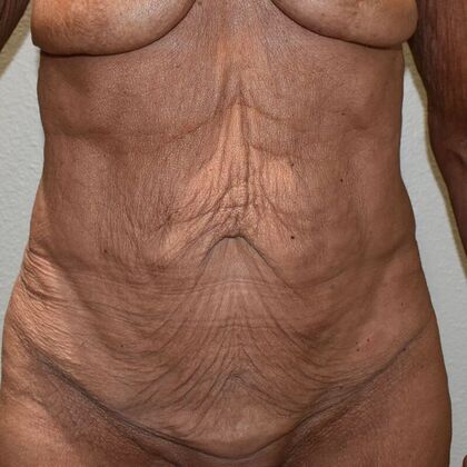 Tummy Tuck (Abdominoplasty): Case 473 - Before