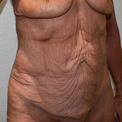 Tummy Tuck (Abdominoplasty): Case 473 - Before