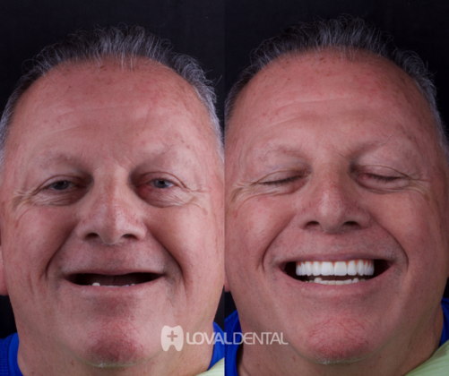 All-on-4 / All-on-6 Case 2