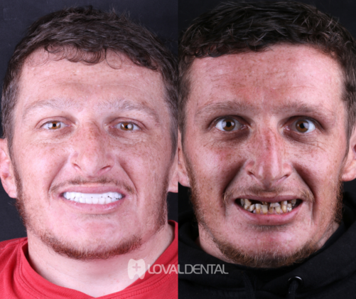 All-on-4 / All-on-6 Case 3