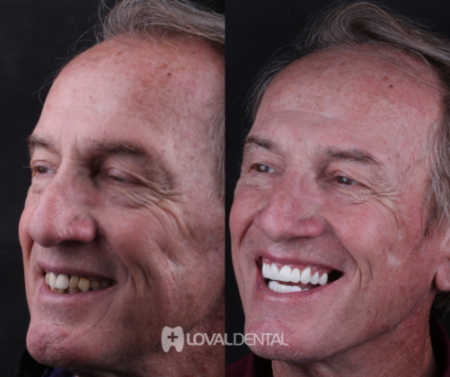 Crowns: Case 3 - Before & After