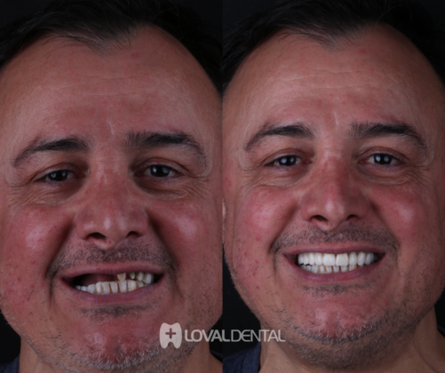 Dental Implants: Case 1 - Before & After