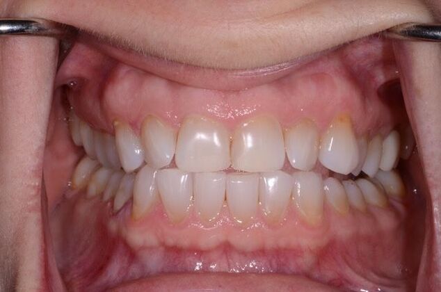 Invisalign Case 1 - Before