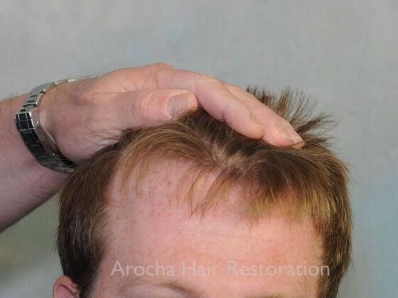 FUT Hair Restoration Case 40 - Before