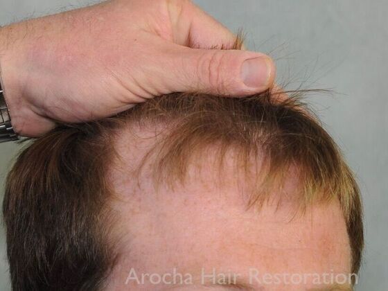 FUT Hair Restoration: Case 40 - Before