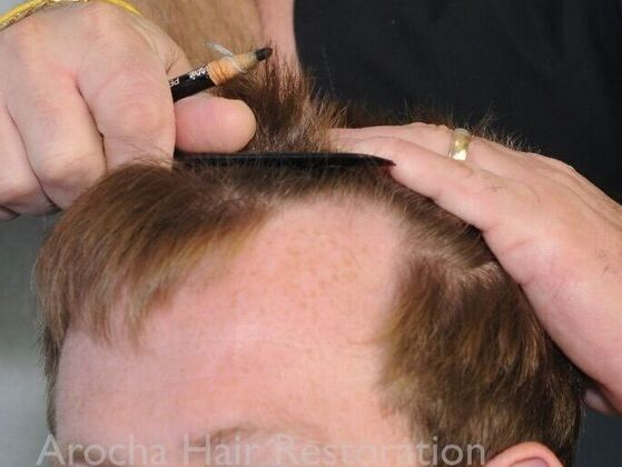 FUT Hair Restoration: Case 40 - Before