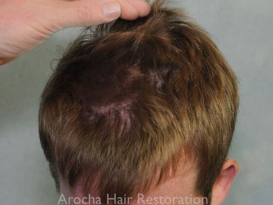 FUT Hair Restoration: Case 40 - Before