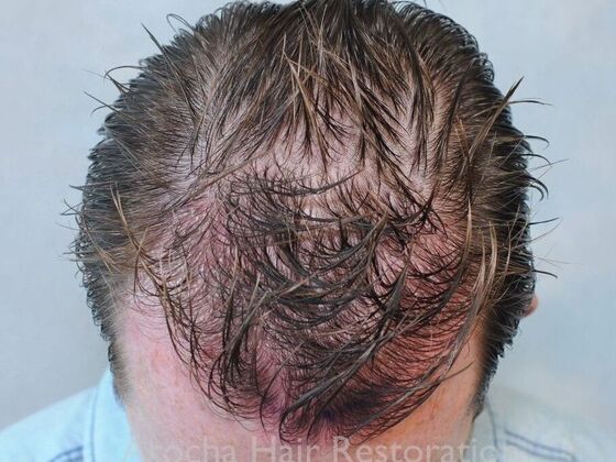 FUT Hair Restoration: Case 40 - Immediately post-op