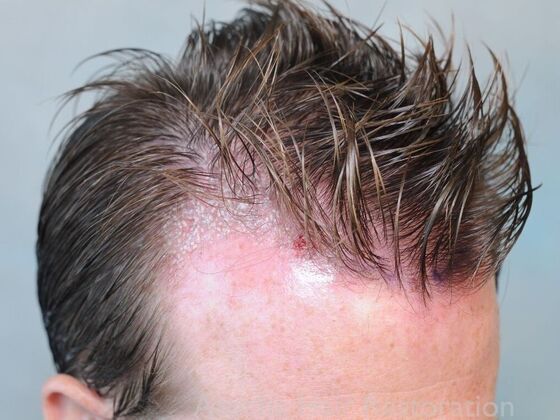 FUT Hair Restoration: Case 40 - Immediately Post-op