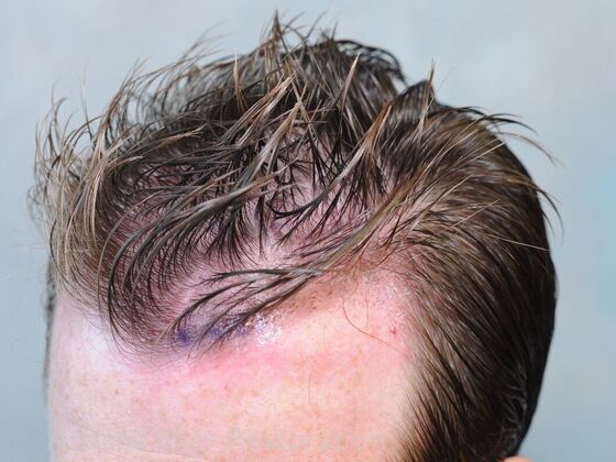 FUT Hair Restoration: Case 40 - Immediately post-op