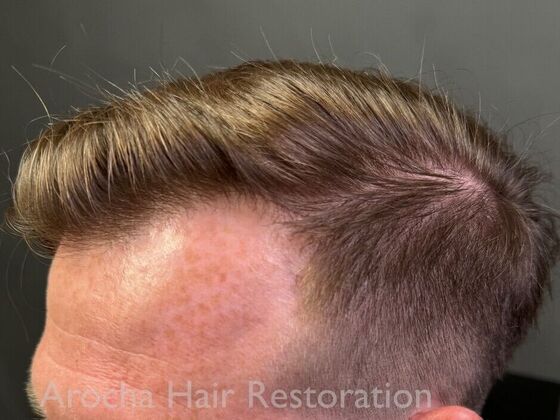 FUT Hair Restoration: Case 40 - After