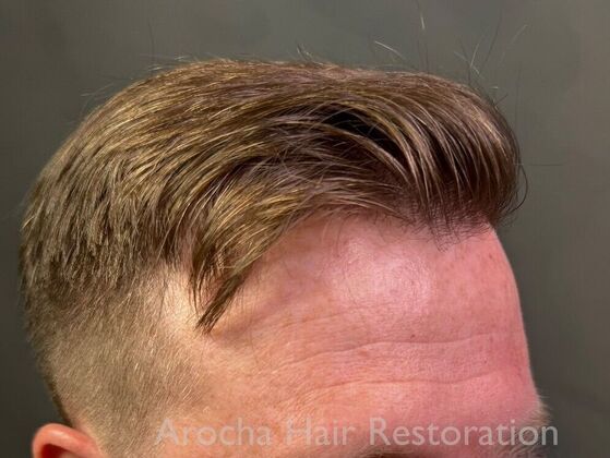 FUT Hair Restoration: Case 40 - After