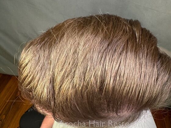 FUT Hair Restoration: Case 40 - After