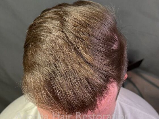 FUT Hair Restoration: Case 40 - After