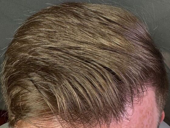 FUT Hair Restoration: Case 40 - After