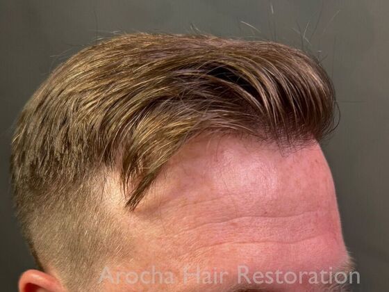 FUT Hair Restoration: Case 40 - After