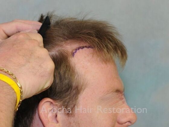 FUT Hair Restoration: Case 40 - Before