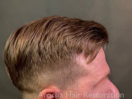 FUT Hair Restoration: Case 40 - After