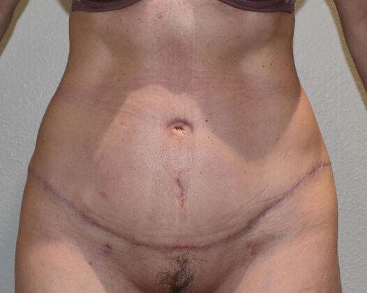 Tummy Tuck (Abdominoplasty): Case 466 - After