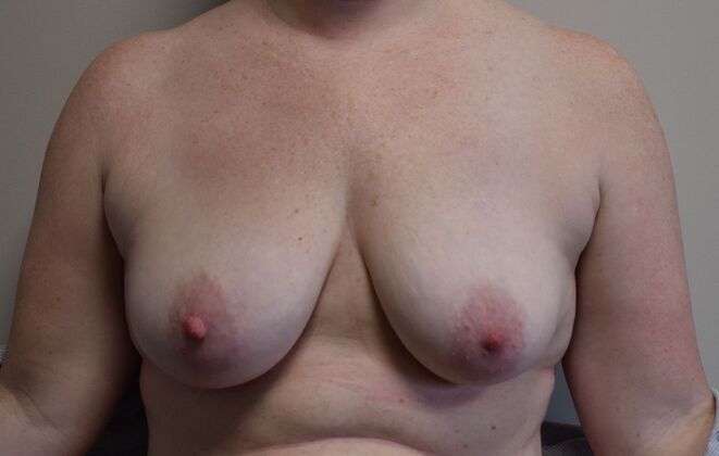 Breast Augmentation w/ Lift Case 531 - Before