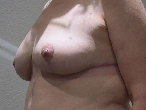 Breast Lift (Mastopexy): Case 198 - After