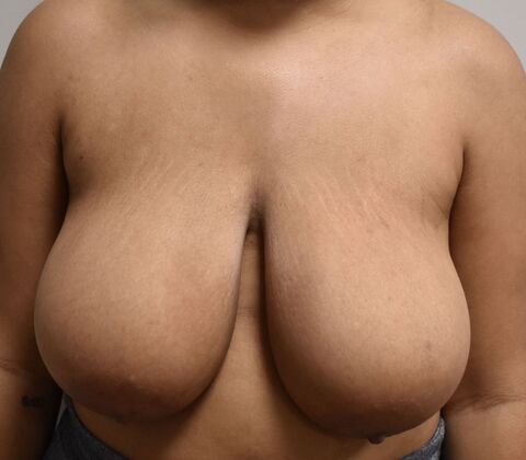 Breast Reduction Case 176 - Before
