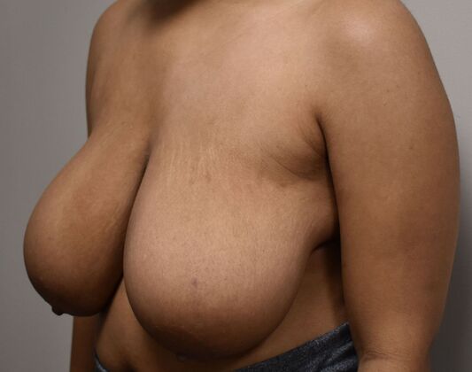 Breast Reduction: Case 176 - Before
