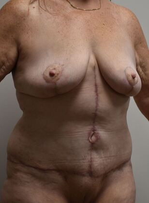 Massive Weight Loss : Case 150 - After