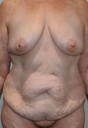 Massive Weight Loss : Case 150 - Before