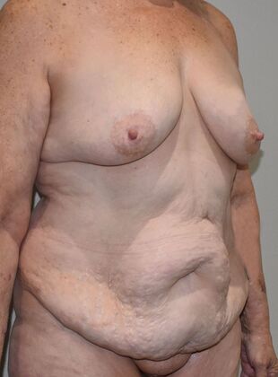 Massive Weight Loss : Case 150 - Before
