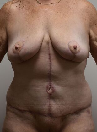 Mommy Makeover Case 303 - After