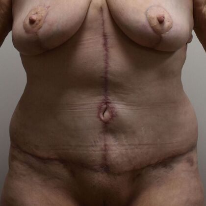 Tummy Tuck (Abdominoplasty): Case 475 - After