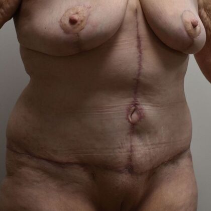 Tummy Tuck (Abdominoplasty): Case 475 - After