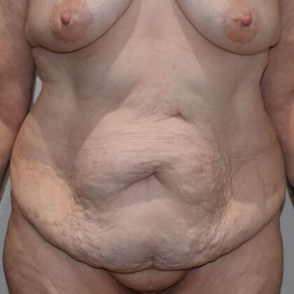 Tummy Tuck (Abdominoplasty): Case 475 - Before