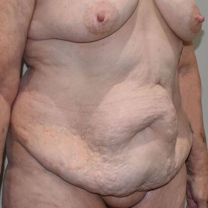 Tummy Tuck (Abdominoplasty): Case 475 - Before